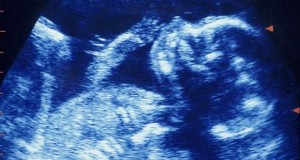 Ultrasound-scan-of-foetus-007