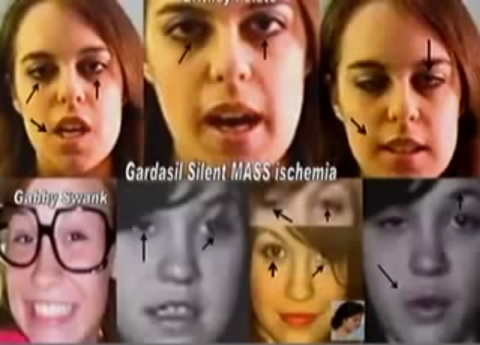 gardasil-mass