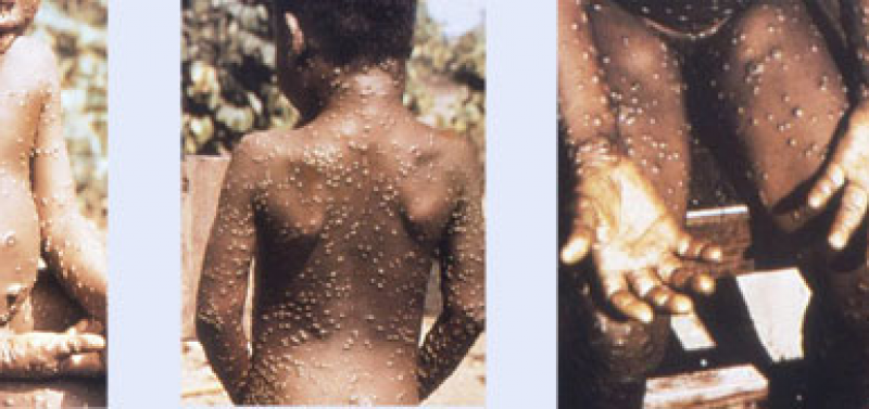 Everything you never thought you’d need to know about Monkeypox