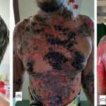 Multiple Cases of Skin Diseases Following COVID-19 Vaccination Start Appearing in the Medical Journals